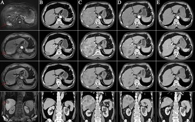 Retreatment with immunotherapy in a patient with hepatocellular carcinoma who received immune checkpoint inhibitors after primary curative treatment: a case report